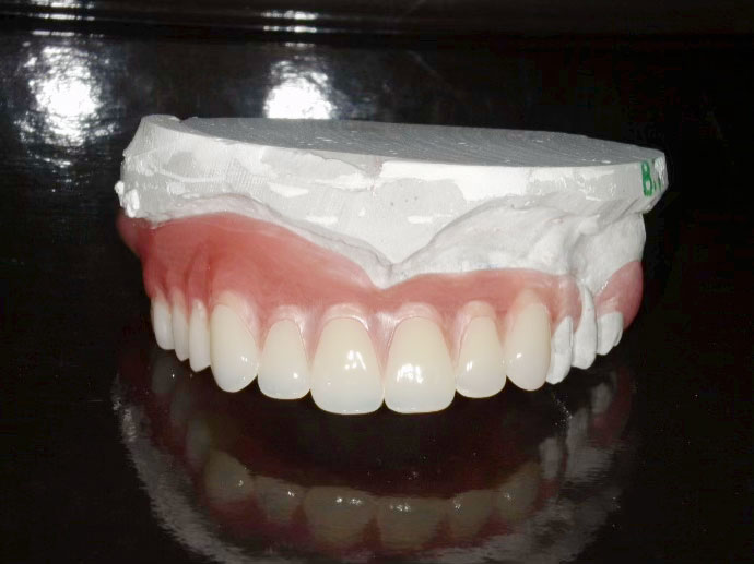 義歯技工物1