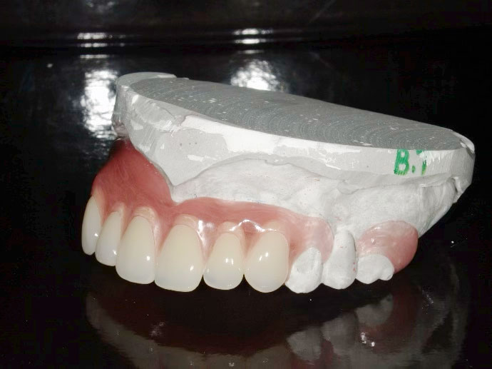 義歯技工物2